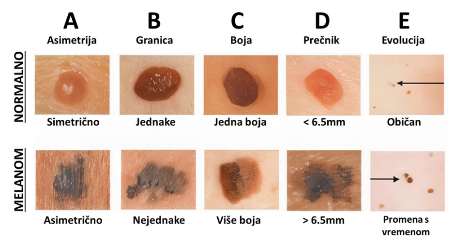 Melanom ABCDE-pravilo; Udruženje pacijenata Osmeh